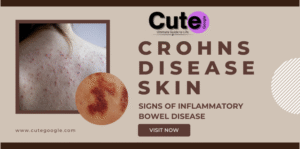Crohns Disease Skin