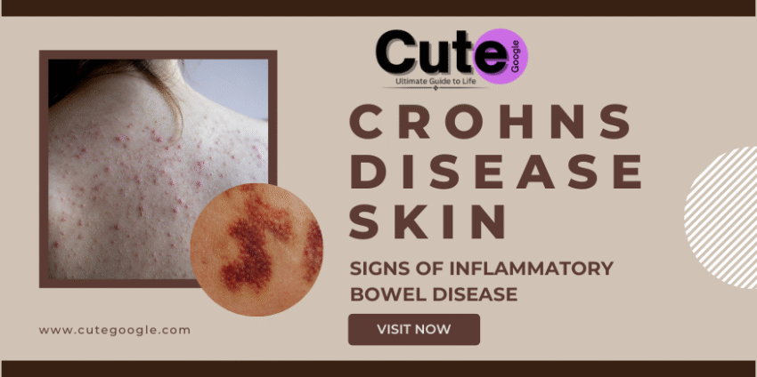 Crohns Disease Skin